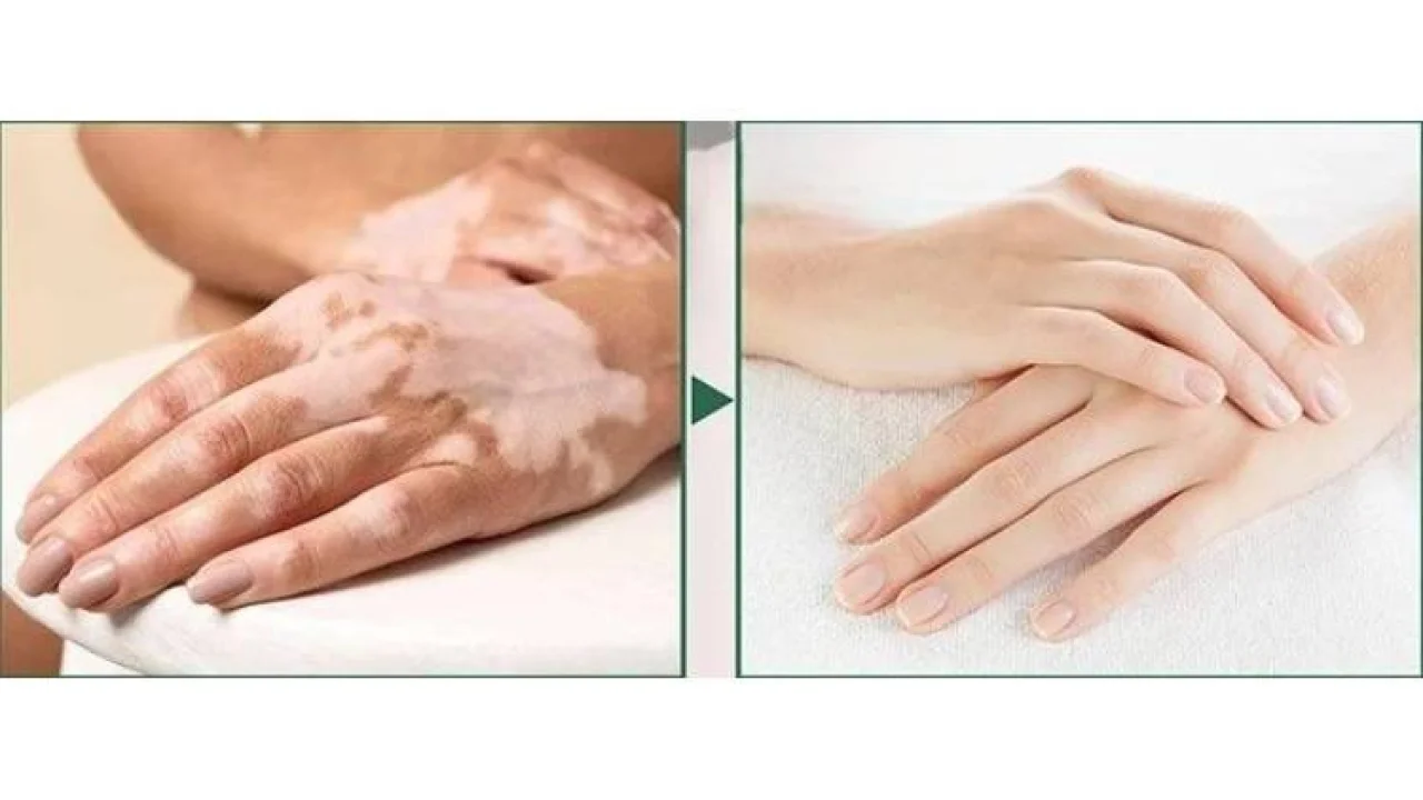 Dünyadaki birçok vitiligo hastası çareyi Bursa’da buluyor -