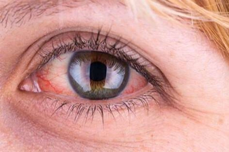 Yaz serinliği göz sağlığınızı tehdit etmesin: 6 koruyucu öneri 