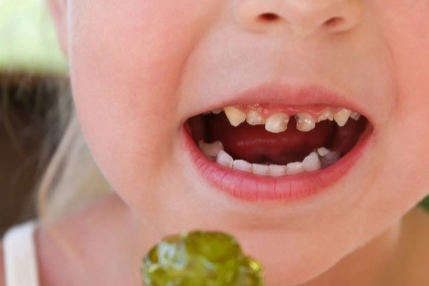 Okul çağındaki çocuklarda çürük riskine dikkat! Paketli gıdalar çocuk dişlerini vuruyor! 