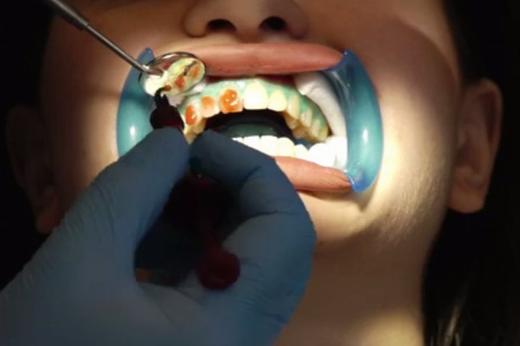 Diş beyazlatma yöntemleri neler? Beyazlatmak dişlere zarar verir mi? -