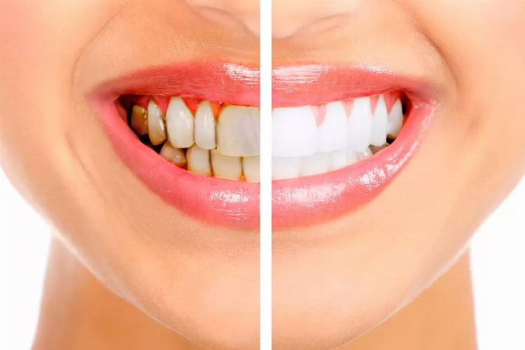 Diş taşı temizliğinin zararı var mı? -
